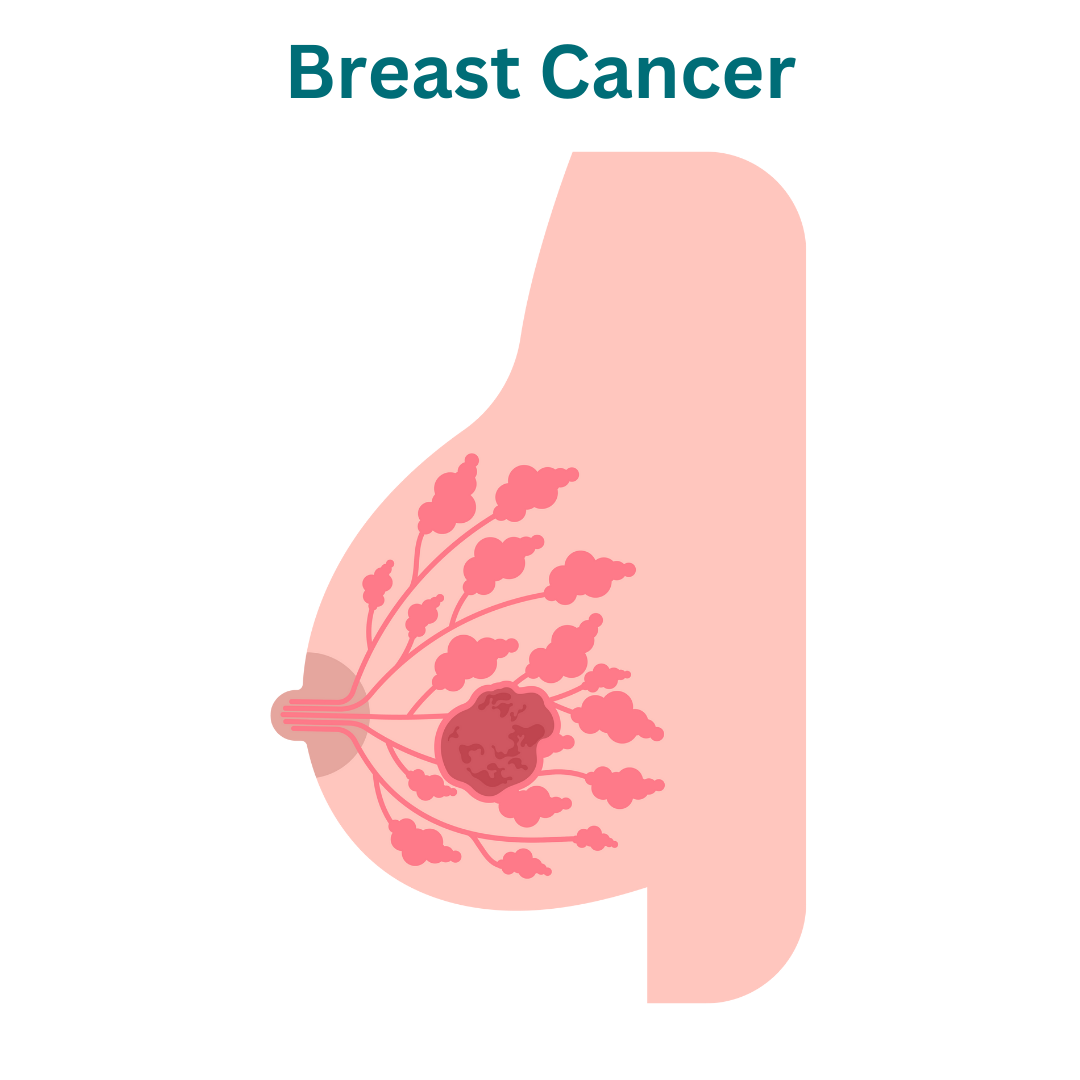 Breast Surgery