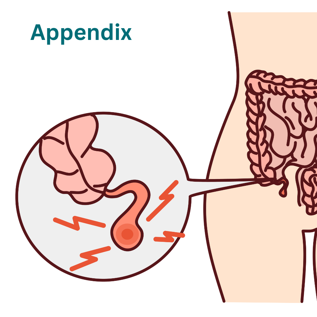 Appendix Treatment in Gurgaon